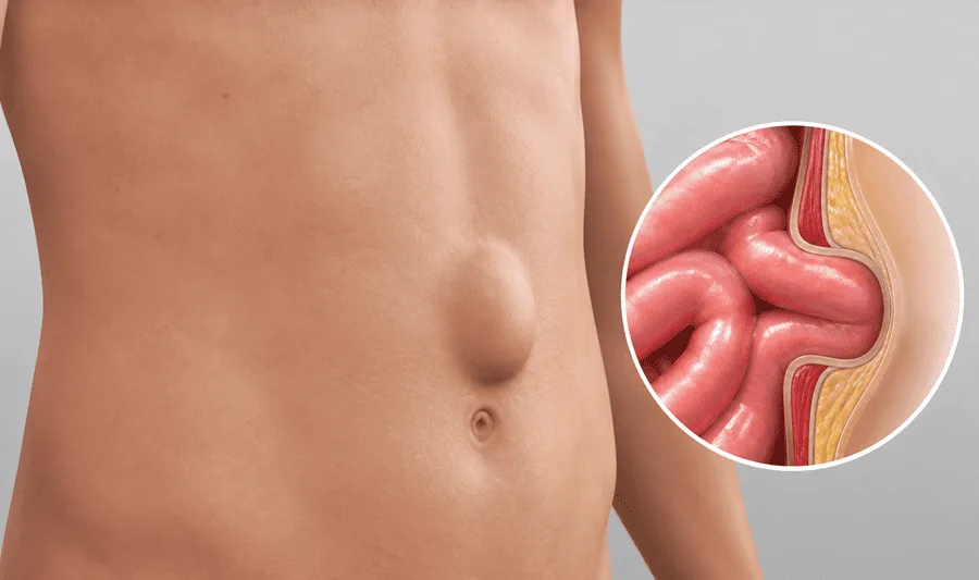 Cirugía de hernia umbilical