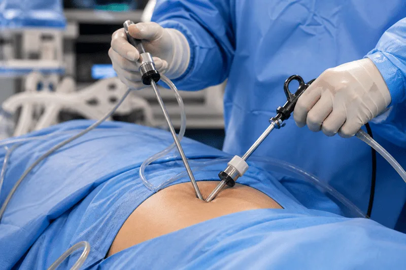 Plastia umbilical